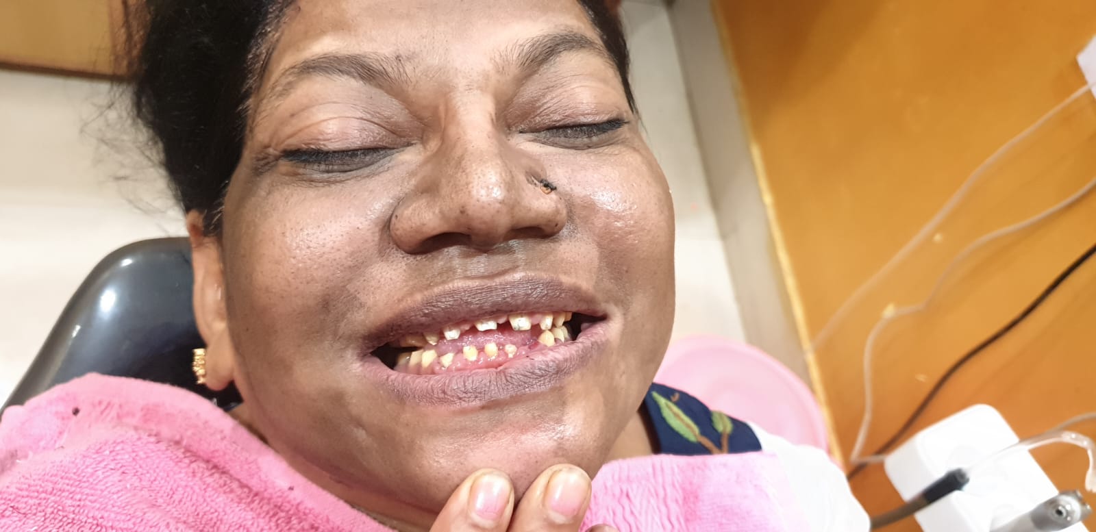 Dental Implant Restoration (Before)