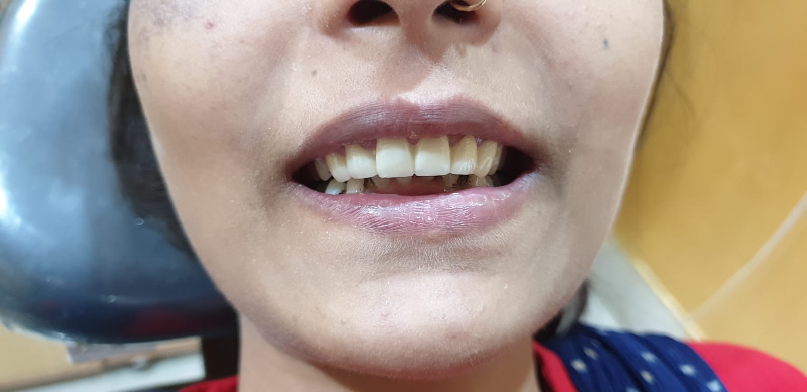 Smile Alignment (After)