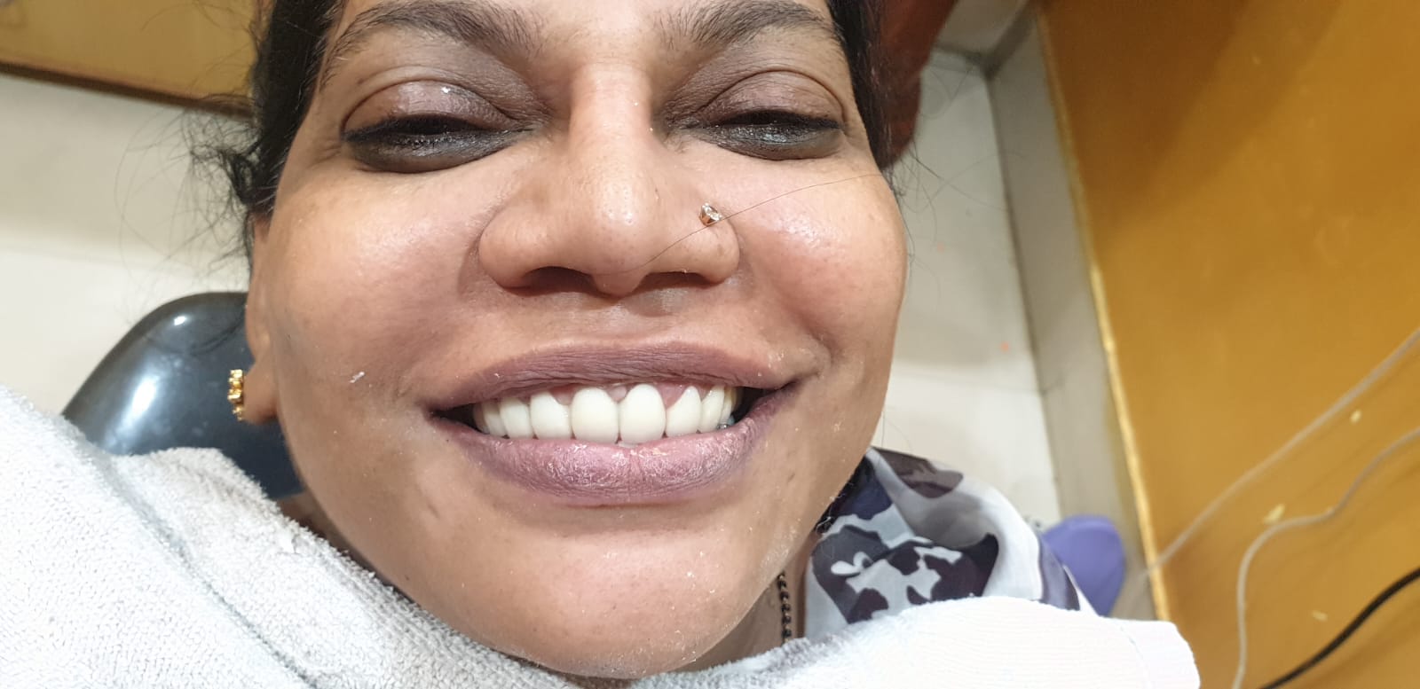 Dental Implant Restoration (After)