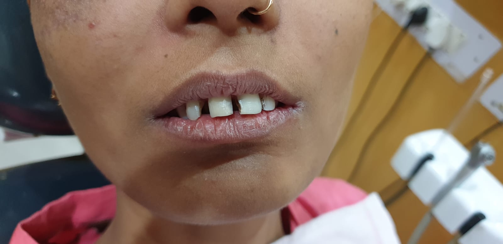 Smile Alignment (Before)